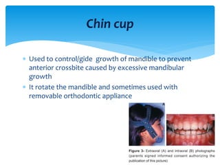  Used to control/gide growth of mandible to prevent
anterior crossbite caused by excessive mandibular
growth
 It rotate the mandible and sometimes used with
removable orthodontic appliance
Chin cup
 
