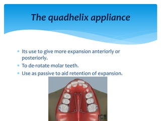  Its use to give more expansion anteriorly or
posteriorly.
 To de-rotate molar teeth.
 Use as passive to aid retention of expansion.
The quadhelix appliance
 