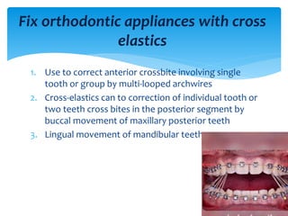 1. Use to correct anterior crossbite involving single
tooth or group by multi-looped archwires
2. Cross-elastics can to correction of individual tooth or
two teeth cross bites in the posterior segment by
buccal movement of maxillary posterior teeth
3. Lingual movement of mandibular teeth
Fix orthodontic appliances with cross
elastics
 