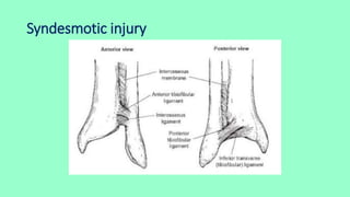 Syndesmotic injury
 