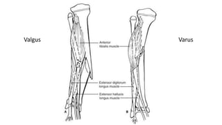 Valgus Varus
 