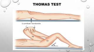 Thomas Test Types nursing assessment and systemic examination of orthopaedic system | PPTX
