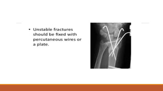Fall Into Outstretched Hand Injuries of fall on outstretched hand ppt | PPTX