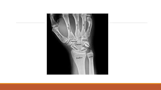 Injuries of fall on outstretched hand ppt | PPTX