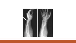 Fall Into Outstretched Hand Injuries of fall on outstretched hand ppt | PPTX