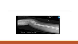 Fall Into Outstretched Hand Injuries of fall on outstretched hand ppt | PPTX