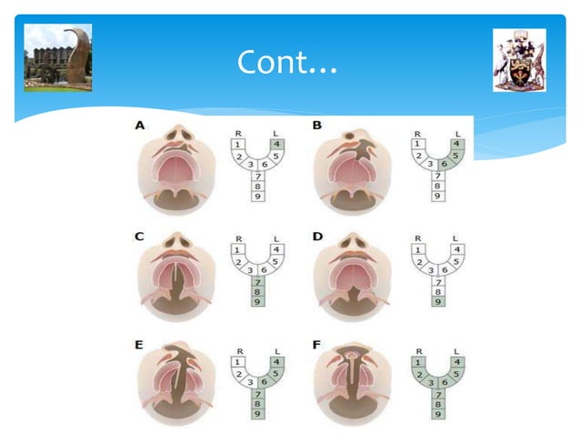 principles of Orthodontic management of cleft lip and palate | PPT ...
