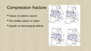 Compression fracture
•Failure of anterior column
•The middle column is intact
•Usually no Neurological deficits
 