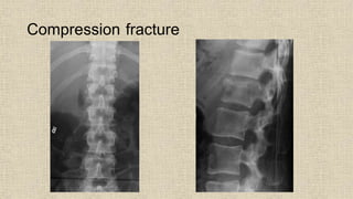 Compression fracture
 