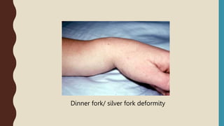 Dinner fork/ silver fork deformity
 