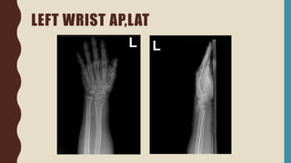 LEFT WRIST AP,LAT
 