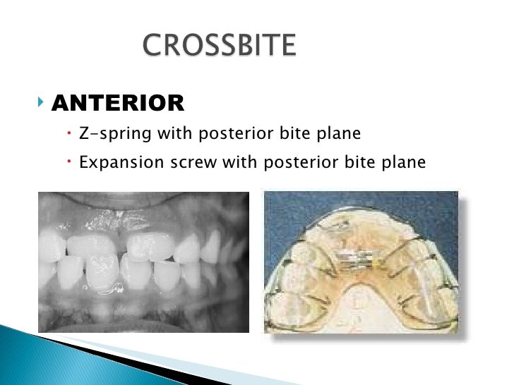 Class1 Malocclusion Ppt Class1 Malocclusion Ppt