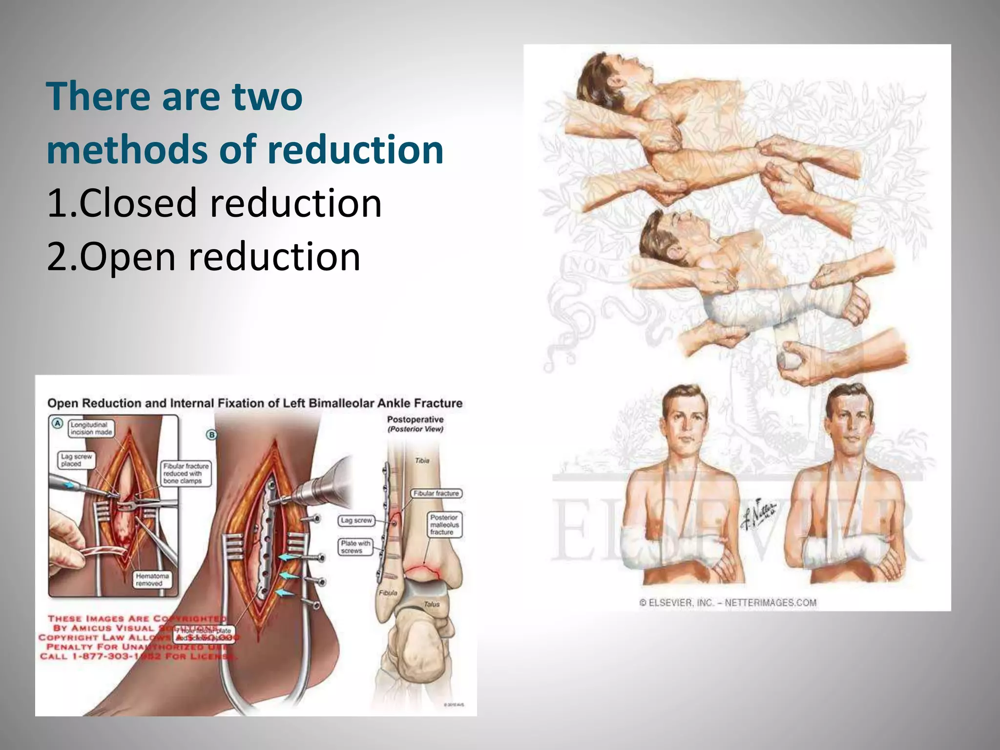 There are two
methods of reduction
1.Closed reduction
2.Open reduction
 
