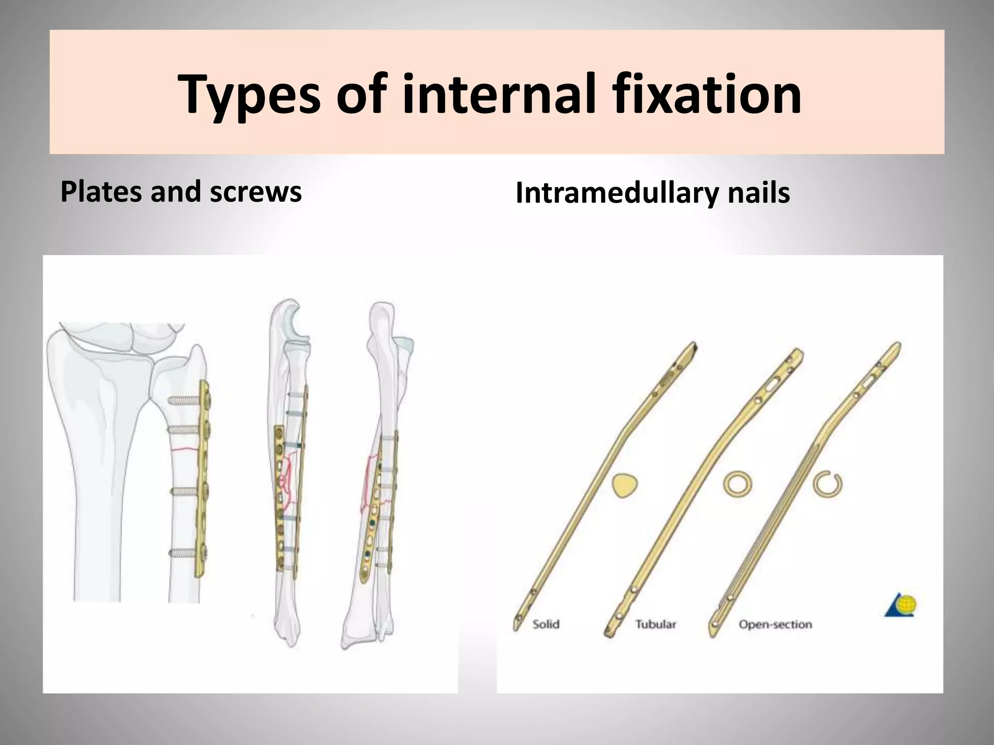Types of internal fixation
Plates and screws Intramedullary nails
 