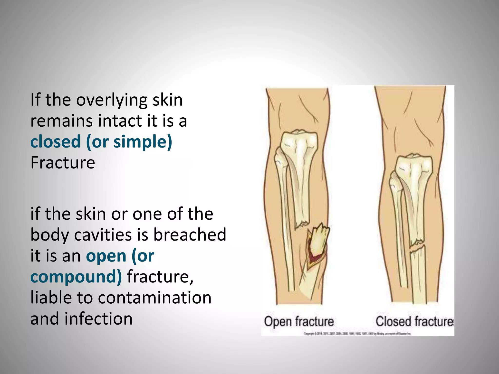 If the overlying skin
remains intact it is a
closed (or simple)
Fracture
if the skin or one of the
body cavities is breached
it is an open (or
compound) fracture,
liable to contamination
and infection
 