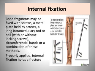 management of closed fracture | PPTX