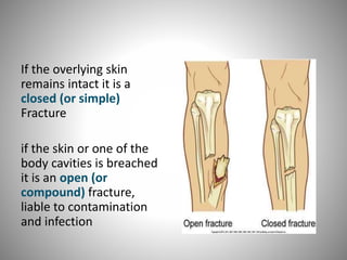 management of closed fracture | PPT