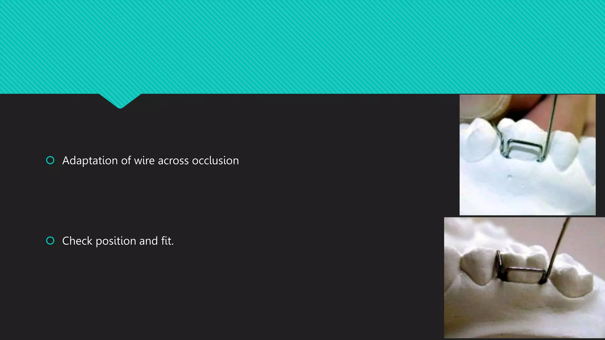 Adams clasp theory and fabrication PPT