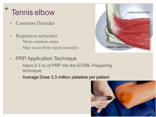 +
Tennis elbow
• Common Disorder
• Repetitive activities
– Most common cause
– May occur from injury (acutely)
• PRP Application Technique
– Inject 2-3 cc of PRP into the ECRB--Peppering
technique
– Average Dose 3.3 million platelets per patient
 