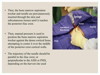 • Then, the bone marrow aspiration
trochar and needle are percutaneously
inserted through the skin and
subcutaneous tissues until it reaches
the posterior iliac crest.
• Then, manual pressure is used to
position the bone marrow aspiration
trochar against the dense cortical bone,
attempting to center it over the middle
of the posterior crest cortical walls.
• The trajectory of the needle should be
parallel to the iliac crest, or
perpendicular to the ASIS or PSIS,
depending on the harvest site used
 