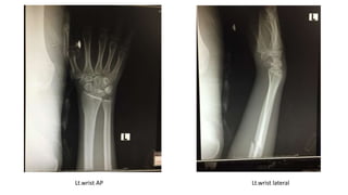 Lt.wrist AP Lt.wrist lateral
 