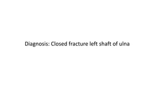 Diagnosis: Closed fracture left shaft of ulna
 