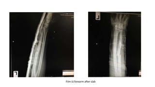 Film Lt.forearm after slab
 