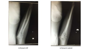 Lt.forearm AP Lt.forearm Lateral
 