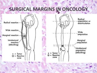 SURGICAL MARGINS IN ONCOLOGY

 