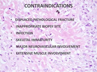CONTRAINDICATIONS
• DISPLACED PATHOLOGICAL FRACTURE

•

INAPPROPRIATE BIOPSY SITE

•

INFECTION

•

SKELETAL IMMATURITY

•

MAJOR NEUROVASCULAR INVOLVEMENT

•

EXTENSIVE MUSCLE INVOLVEMENT

 