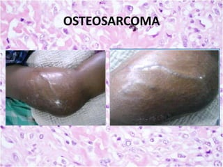 OSTEOSARCOMA

 