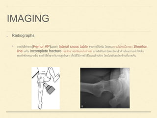 IMAGING
Radiographs
• ภาพรังสีท่าตรง(Femur AP)และท่า lateral cross table ช่วยการวินิจฉัย โดยพบความไม่ต่อเนื่องของ Shenton
line แต่ใน incomplete fracture รอยหักอาจไม่ชัดเจนในท่าตรง ภาพรังสีในท่าบิดสะโพกเข้าด้านในจะช่วยทาให้เห็น
รอยหักชัดเจนมากขึ้น ฉายรังสีตั้งฉากกับกระดูกต้นขา เพื่อให้ได้ภาพรังสีในแนวด้านข้าง โดยไม่ขยับสะโพกด้านที่บาดเจ็บ
 