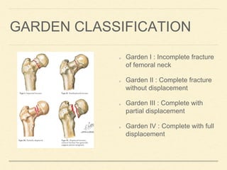 GARDEN CLASSIFICATION
Garden I : Incomplete fracture
of femoral neck
Garden II : Complete fracture
without displacement
Garden III : Complete with
partial displacement
Garden IV : Complete with full
displacement
 