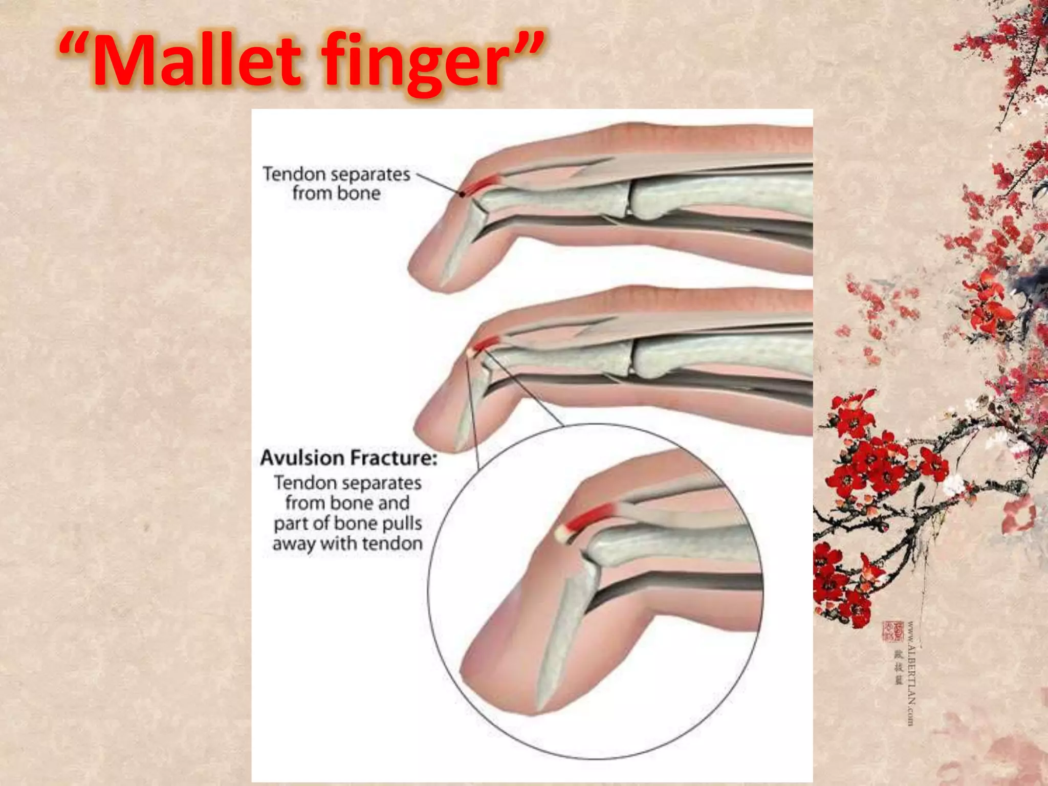 “Mallet finger”
 