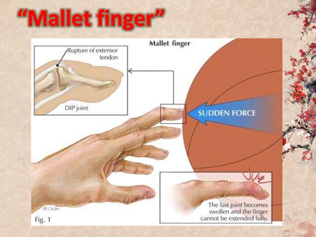 Mallet finger