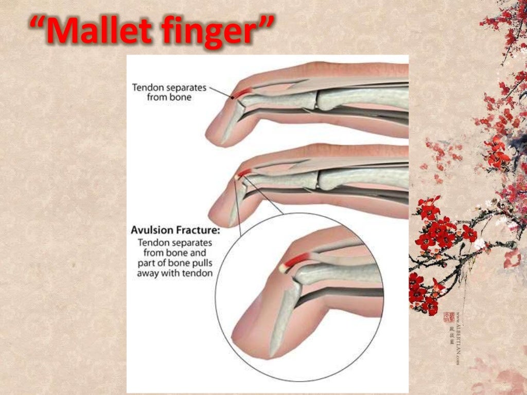Mallet finger