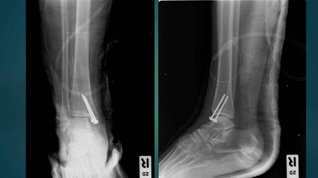 maisonneuve fracture maisonneuve fracture
