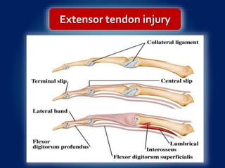Extensor tendon injury
 