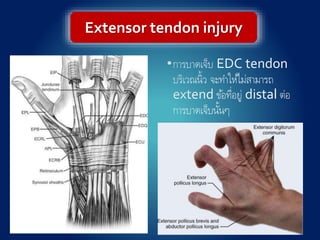 Extensor tendon injury
 