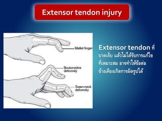 Extensor tendon ที่
บาดเจ็บ แล้วไม่ได้รับการแก้ไข
ที่เหมาะสม อาจทาให้ข้อต่อ
ข้างเคียงเกิดการผิดรูปได้
Extensor tendon injury
 