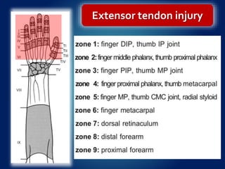 Extensor tendon injury
 
