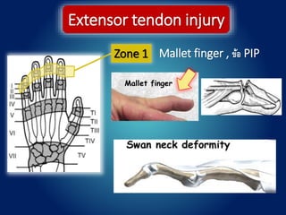 Zone 1
Extensor tendon injury
Mallet finger , ข้อ PIP
 