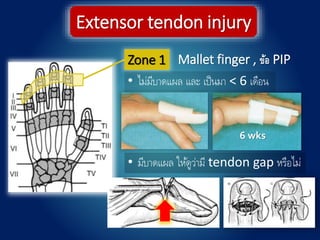 Zone 1
Extensor tendon injury
Mallet finger , ข้อ PIP
• ไม่มีบาดแผล และ เป็นมา < 6 เดือน
• มีบาดแผล ให้ดูว่ามี tendon gap หรือไม่
6 wks
 