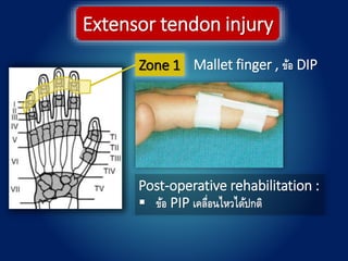 Zone 1
Extensor tendon injury
Mallet finger , ข้อ DIP
Post-operative rehabilitation :
 ข้อ PIP เคลื่อนไหวได้ปกติ
 