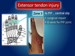 Zone 3
Extensor tendon injury
ข้อ PIP , central slip
• surgical repair
• K-wire fix PIP joint
 