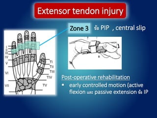 Zone 3
Extensor tendon injury
ข้อ PIP , central slip
Post-operative rehabilitation
 early controlled motion (active
flexion และ passive extension ข้อ IP
 