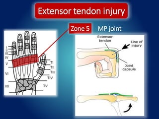 Extensor tendon injury
Zone 5 MP joint
 