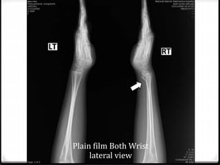 Plain film Both Wrist
lateral view
 