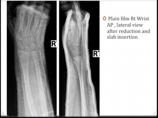 0 Plain film Rt Wrist
AP , lateral view
after reduction and
slab insertion
 