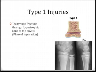 Type 1 Injuries
0 Transverse fracture
through hypertrophic
zone of the physis
(Physeal separation)
 